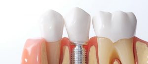 Massachusetts Boston Best Dental Implant Price $1750 Best Dentist ABS