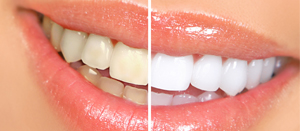 Best Teeth Whitening in Massachusetts